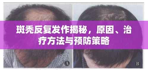 斑秃反复发作揭秘,原因、治疗方法与预防策略
